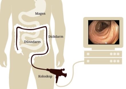 Illustration einer Darmspiegelung